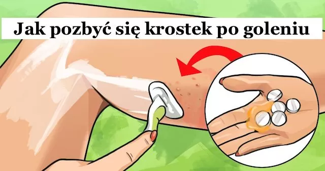 Jak usunąć czerwone krostki po goleniu - Gosia Klos